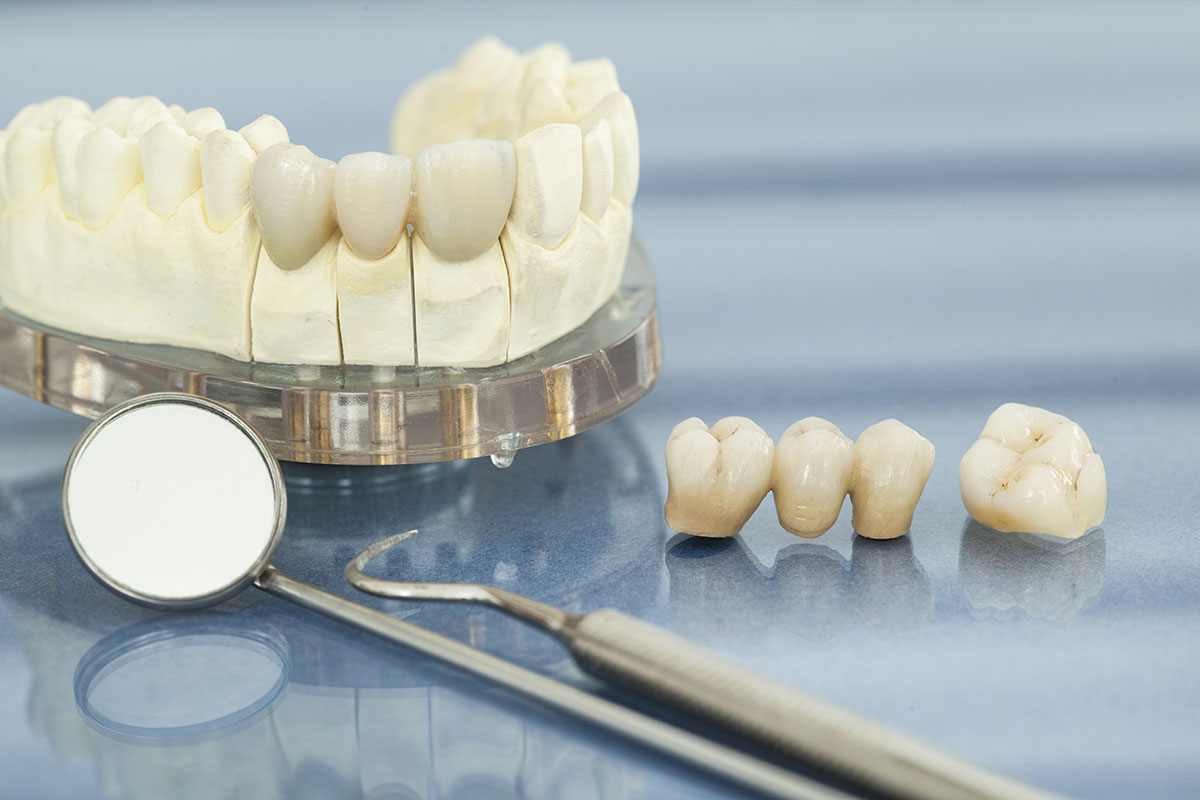 Crown and Bridges at OraCare Cosmetic Dental Clinic Gurgaon